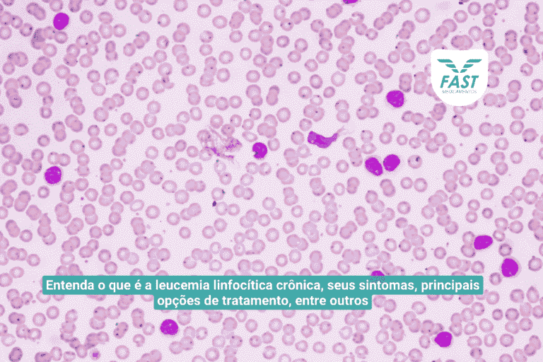Ilustração da leucemia linfocítica crônica