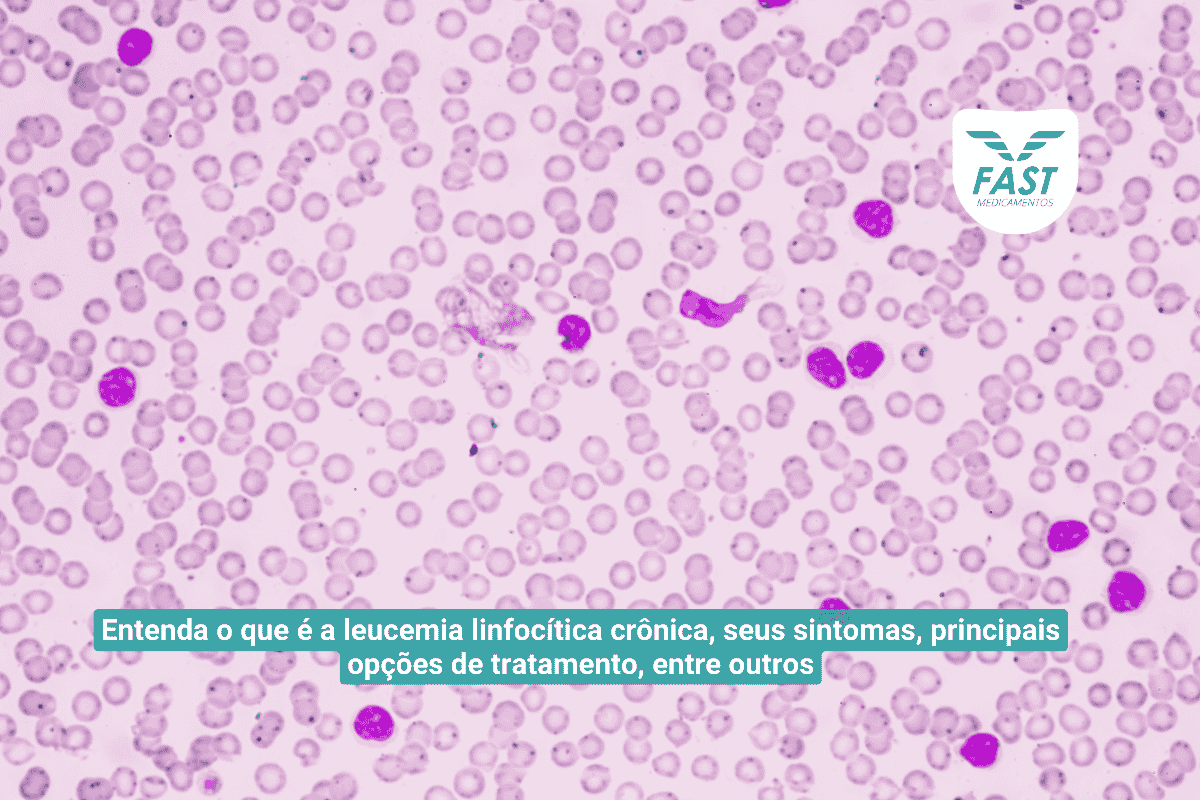 Ilustração da leucemia linfocítica crônica