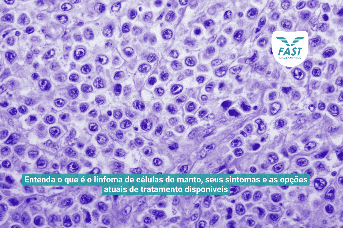 Representação da doença linfoma de células do manto