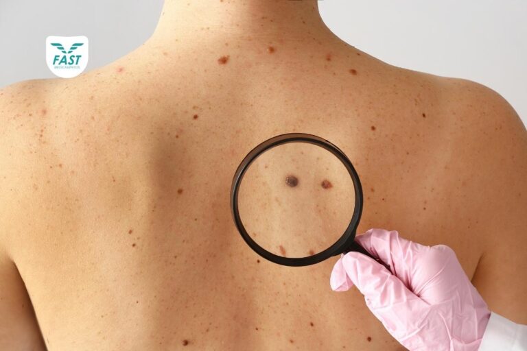 Lupa mostrando pintas de melanoma em costas de uma pessoa