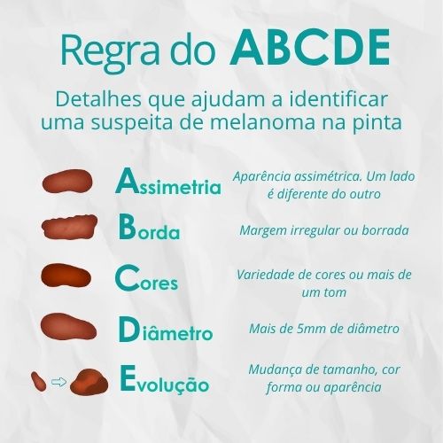 Infográfico de regra ABCDE para identificar suspeita de melanoma na pinta