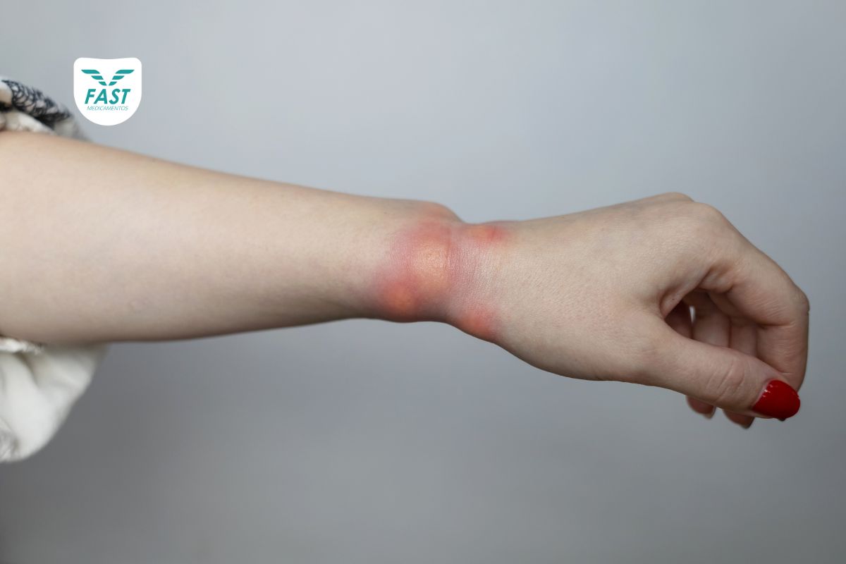 Braço de mulher com angioedema hereditário